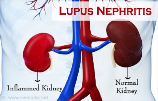 Viêm thận lupus - Hình ảnh minh họa